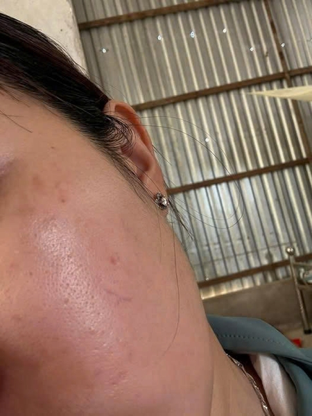 Da đang hơi đỏ và lỗ chân lông to có nên 