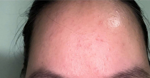 Sau sinh trán nổi mụn li ti kèm ngứa, có mẹ bỉm nào bị giống em không? 😭