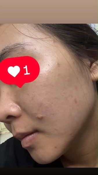 Da dầu, nhiều mụn và thâm thì bắt đầu skincare từ đâu ạ?