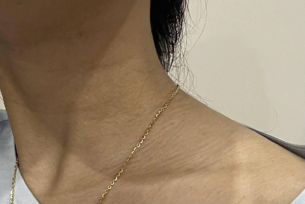 Da cổ bị vằn vện và nếp nhăn, liệu có phải là vết rạn không ạ?