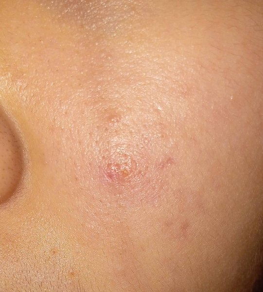 Bị mụn dai dẳng 4 năm, da lúc nào cũng đỏ ửng thì dùng gì cho dịu ạ?