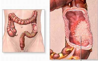 Nấm linh chi có chữa được chứng viêm đại tràng co thắt?