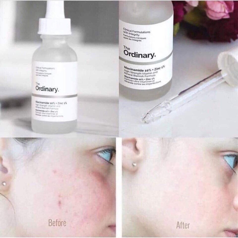 The Ordinary Tinh Chất Trị Thâm Mụn Niacinamide 10% + 1% Zinc