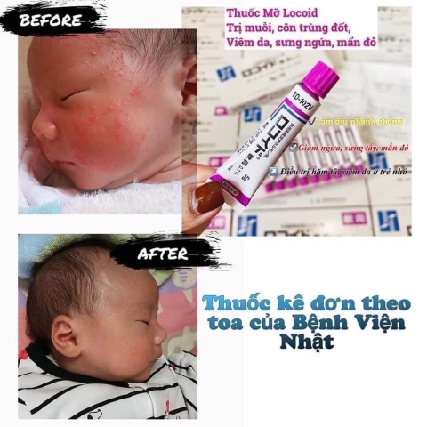 Thuốc kem kháng sinh trị muỗi đốt viêm da ROKOITO