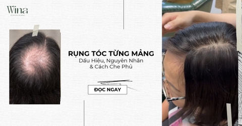 Rụng Tóc Từng Mảng: Dấu Hiệu, Nguyên Nhân & Cách Che Phủ