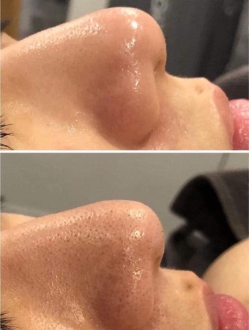 Ủ mụn đầu đen Remove Blackheads làm sạch sợi bã nhờn 50ml - Mỹ