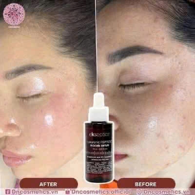 SERUM KẼM EKSEPTION ZNPCA KIỀM DẦU, MỤN, CẤP NƯỚC, LÀNH DA NHANH