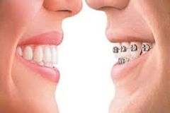 Invisalign – Niềng răng không mắc cài