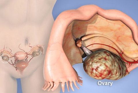 Tìm hiểu các dấu ấn ung thư của 5 loại ung thư hay gặp ở nữ