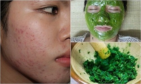 Những bí quyết trị mụn trứng cá bằng rau má đơn giản