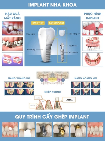 IMPLANT NHA KHOA