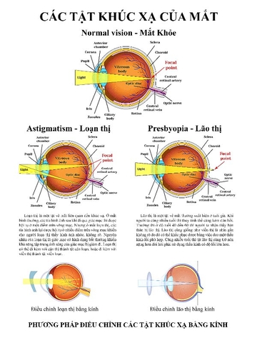 CÁC TẬT KHÚC XẠ CỦA MẮT