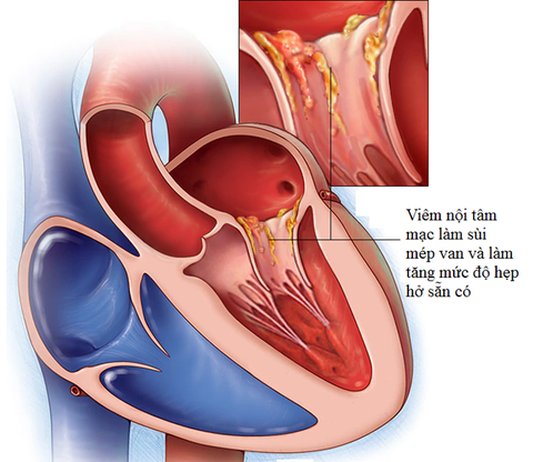 Viêm nội tâm mạc nhiễm khuẩn (P1)