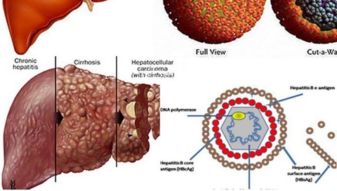 TỔNG QUÁT TÌNH HÌNH BỆNH LÝ VIÊM GAN VIRUT