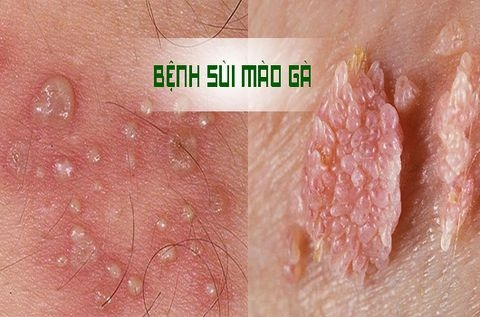 Hiểu biết cơ bản về HPV đối với bệnh lý đường sinh dục