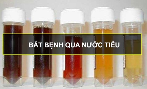 Xét nghiệm nước tiểu phát hiện bệnh gì