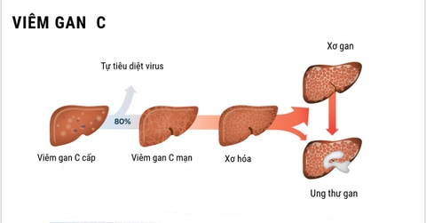 Chỉ định và điều trị viêm gan C