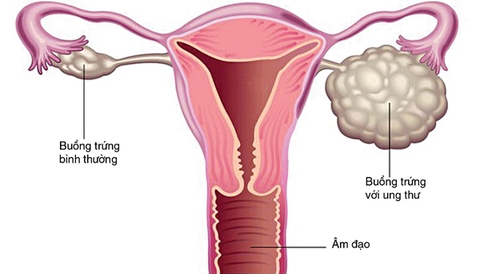 CA 125: Dấu ấn ung thư buồng trứng