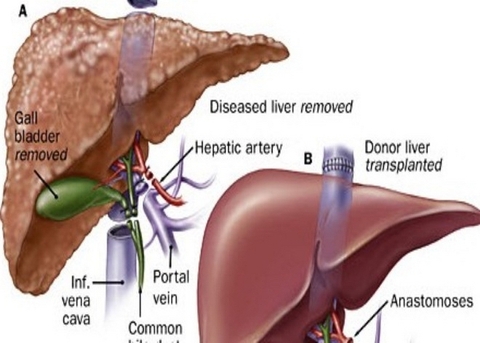 Viêm gan tự miễn - có gì mới trong chẩn đoán và điều trị? (phần 2)