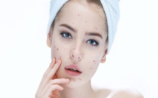 Nguyên nhân gây ra mụn trứng cá của 1 số thực phẩm