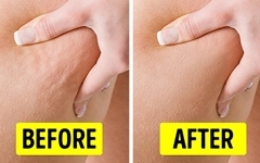 Sai lầm 40: Kem có thể giúp loại bỏ Cellulite