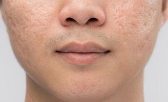 Sẹo do mụn và lời khuyên từ bác sĩ da liễu quốc tế