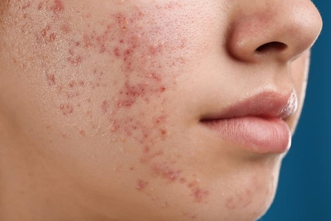 Miếng dán vi kim kết hợp với sóng siêu âm để tiêu diệt vi khuẩn gây mụn