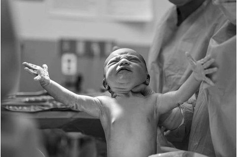 Kích thích chuyển dạ bằng bong bóng an toàn hơn cho trẻ sơ sinh