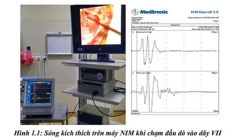 Nghiên cứu áp dụng kỹ thuật sinh học phân tử và chẩn đoán hình ảnh để nâng cao chất lượng chẩn đoán, điều trị điếc bẩm sinh ở trẻ em bằng cấy ốc tai điện tử