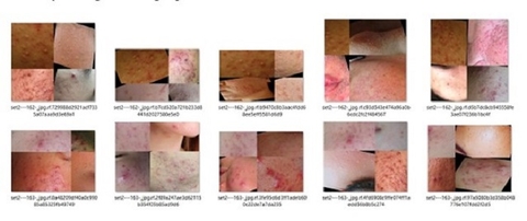 Sử dụng trí tuệ nhân tạo chẩn đoán mụn da mặt