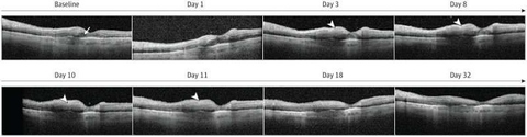 Phát hiện tác dụng phụ sau điều trị các bệnh về mắt bằng faricimab