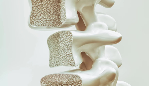 Chuyển hóa tế bào mỡ thành xương để điều trị gãy xương