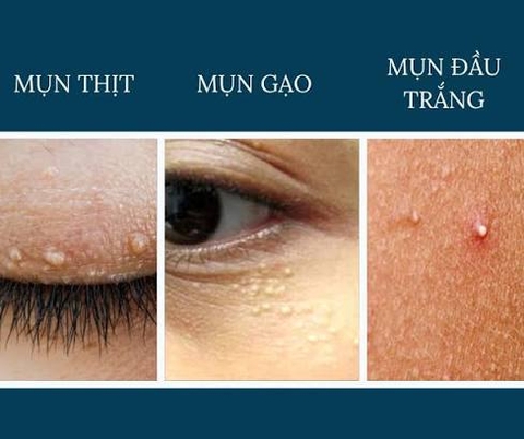 Cách chăm sóc mụn gạo xung quanh mắt.