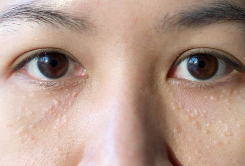 Hướng dẫn cách ngăn mụn thịt lây lan