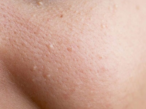 Nốt sần trên da: Nguyên nhân, dấu hiệu và cách xử lý