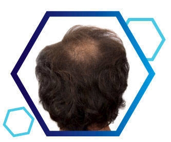 Thuốc mọc râu tóc Minoxidil 5% dạng foam