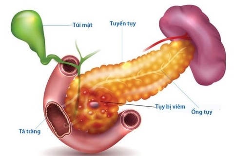 Viêm tụy cấp: Nguyên nhân, triệu chứng, phương pháp chuẩn đoán & điều trị