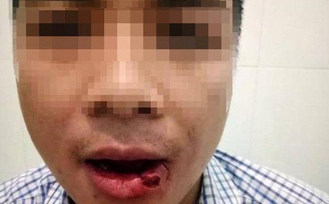 Khởi tố thầy giáo ném tuýp sắt gây thương tích cho thư ký tòa án