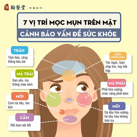 VỊ TRÍ MỤN MỌC TRÊN MẶT CỦA BẠN NÓI LÊN ĐIỀU GÌ?