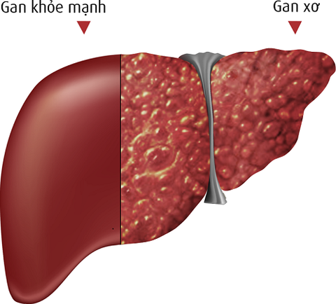 GÓI XÉT NGHIỆM PHÁT HIỆN SỚM XƠ GAN
