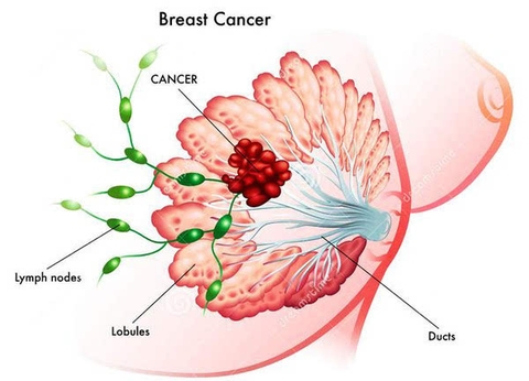 CA 15-3: MARKER UNG THƯ VÚ