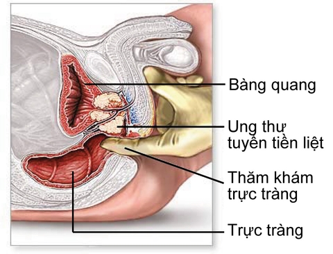 GÓI XÉT NGHIỆM SÀNG LỌC UNG THƯ TIỀN LIỆT TUYẾN