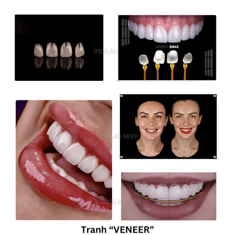 Gợi ý 1 số mẫu tranh "Veneer - Mặt dán sứ thẩm mỹ" trang trí phòng khám Nha khoa