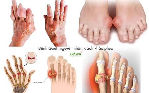 Bệnh Gout : một loại viêm khớp gây ra đau và sưng nặng ở các khớp