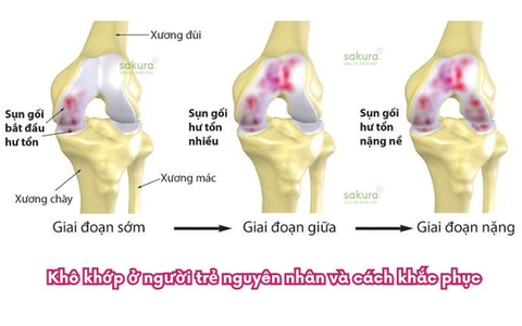 Khô khớp ở người trẻ nguyên nhân và cách khắc phục