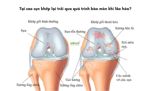Tại sao sụn khớp lại trải qua quá trình bào mòn khi lão hóa?