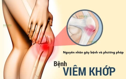 Viêm khớp là gì? Nguyên nhân và phương pháp phòng ngừa bệnh