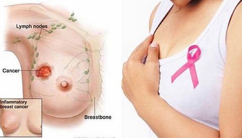 Bị u vú có uống được collagen không?