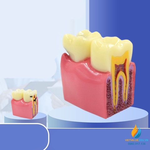 Mô hình giải phẫu răng sâu và răng không sâu, mô hình cấu trúc răng sâu