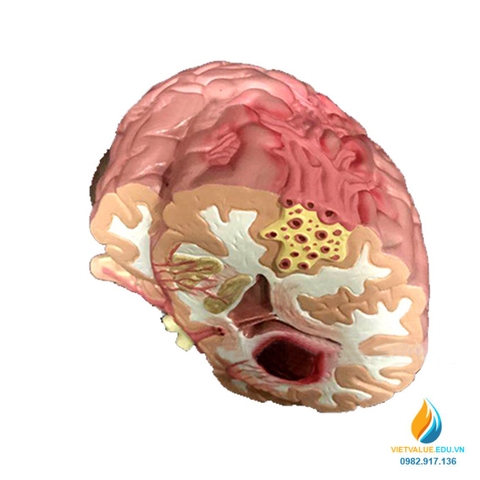 Mô hình bệnh lý não và cấu trúc, chất liệu nhựa PVC, mô hình y khoa